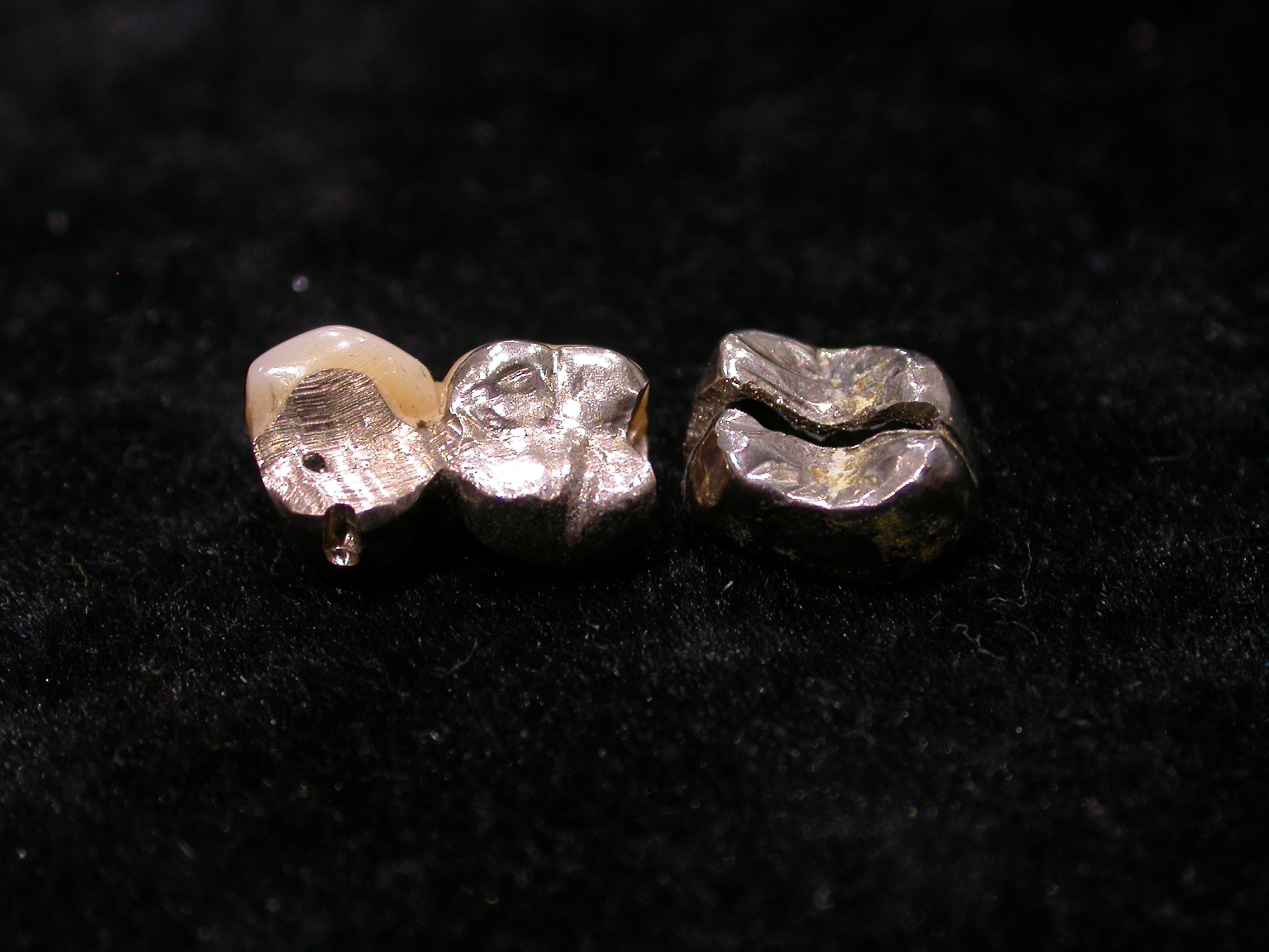 歯科　銀歯　金パラ　銀合金　金属